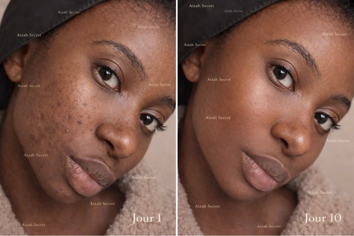 Routine Peau Nette – 10 jours (Peaux grasses & imperfections)